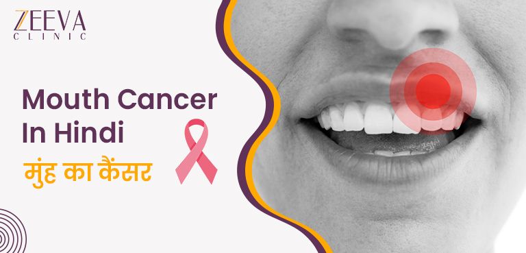 Mouth Cancer Symptoms In Hindi (2023)