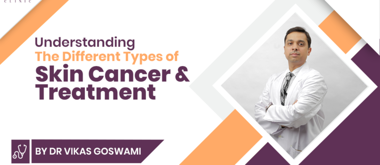 Understanding the Different Types of Skin Cancer & Treatment