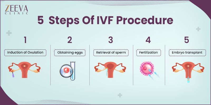 5 Steps Of IVF Procedure 