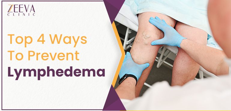 Top 4 Ways To Prevent Lymphedema