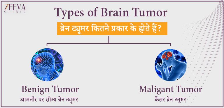Types of Brain Tumor