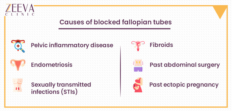 Causes Of Blocked Fallopian Tubes