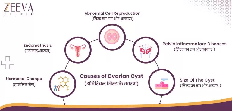 Causes of Ovarian Cyst In Hindi