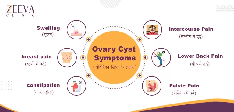 Ovary Cyst Symptoms In Hindi