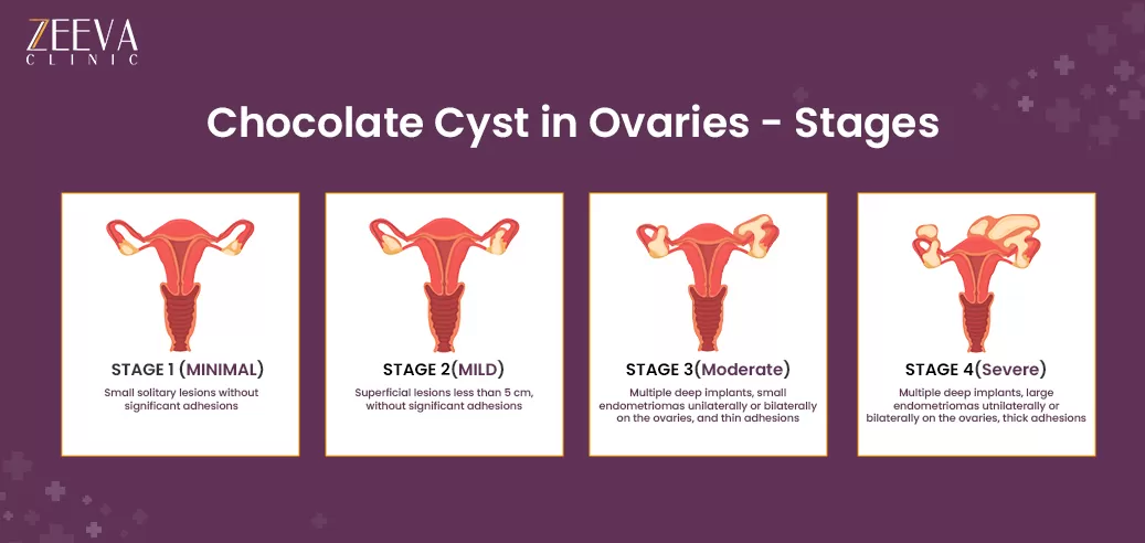 Stages of Chocolate Cyst in Ovaries 